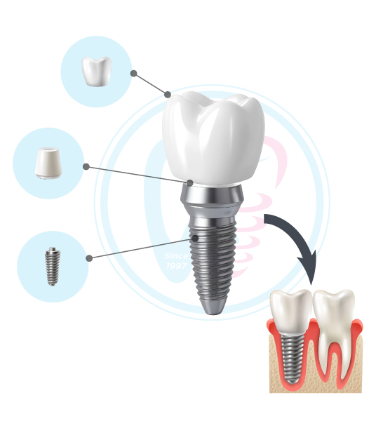Cấu tạo răng Implant Cấu tạo răng Implant gồm 3 phần
