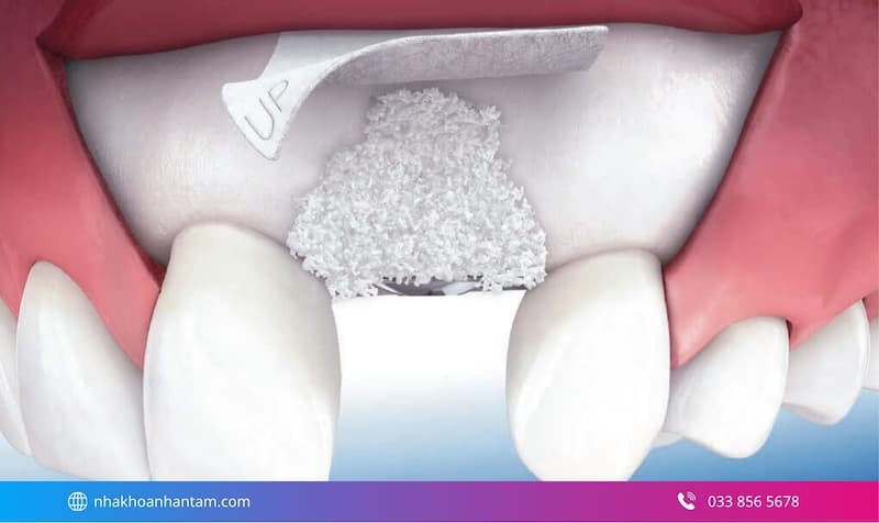 ghép xương cho người tiêu xương hàm Hình: ghép xương cho người tiêu xương hàm