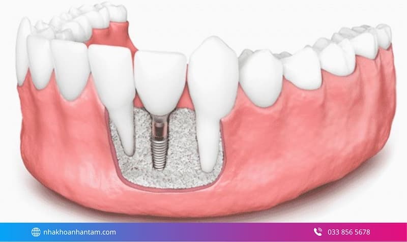 ghép xương có cần thiết không Hình: ghép xương có cần thiết không