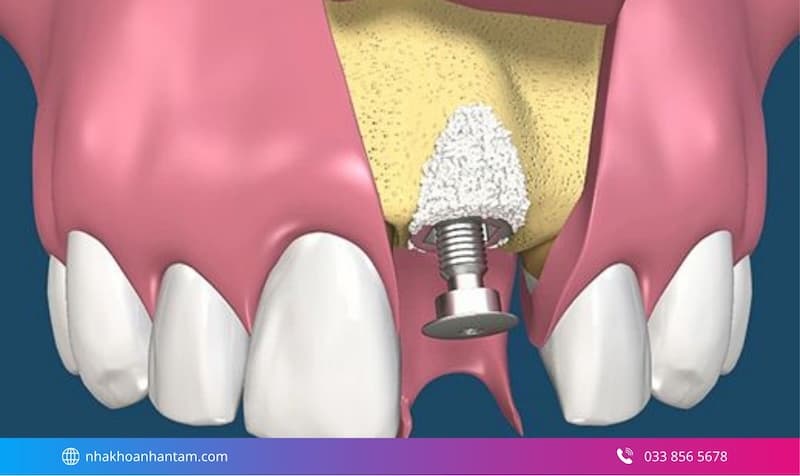 ghép xương trong cấy ghép implant Hình: ghép xương trong cấy ghép implant