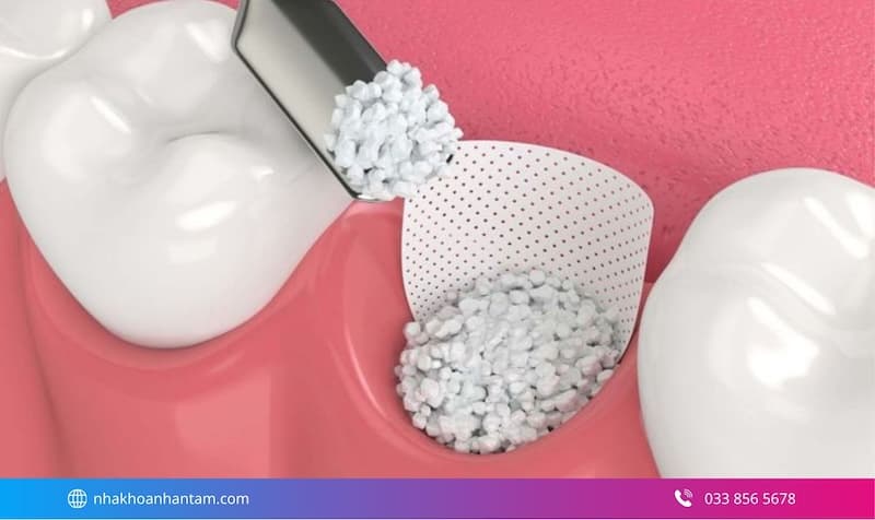tại sao phải ghép xương khi cấy implant Hình: tại sao phải ghép xương khi cấy implant