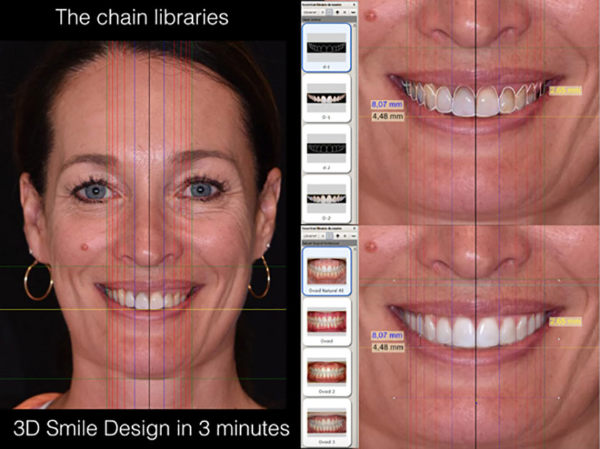 Quy trình thực hiện dán sứ veneer chuẩn Quốc tế